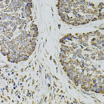 Immunohistochemistry of paraffin-embedded Human esophageal cancer using SELP Polyclonal Antibody at dilution of  1:100 (40x lens).