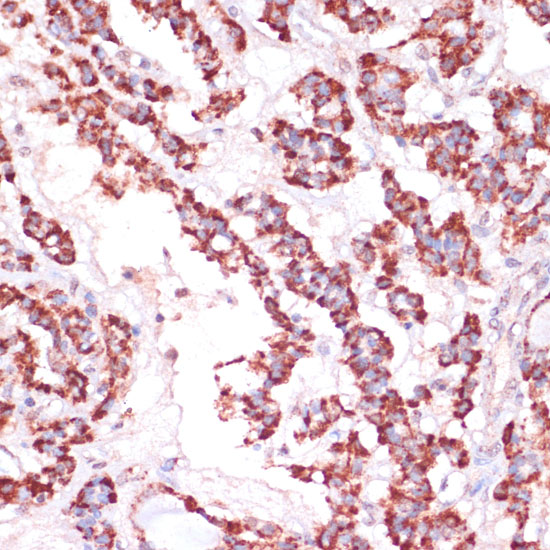 Immunohistochemistry of paraffin-embedded Human thyroid cancer using RPL24 Polyclonal Antibody at dilution of  1:100 (40x lens).