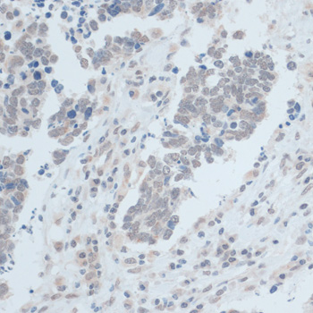 Immunohistochemistry of paraffin-embedded Human lung cancer using ZNF703 Polyclonal Antibody at dilution of  1:100 (40x lens).