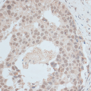 Immunohistochemistry of paraffin-embedded Human breast cancer using ZNF703 Polyclonal Antibody at dilution of  1:100 (40x lens).