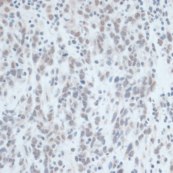 Immunohistochemistry of paraffin-embedded Human gastric cancer using ZNF703 Polyclonal Antibody at dilution of  1:100 (40x lens).