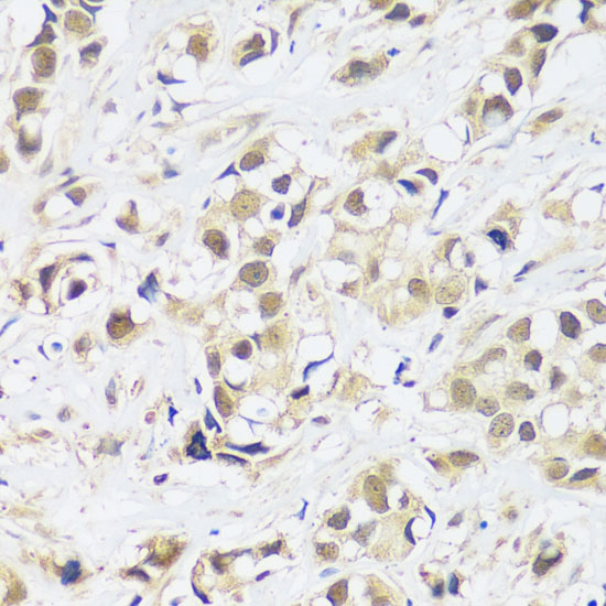 Immunohistochemistry of paraffin-embedded Human breast cancer using ASCL4 Polyclonal Antibody at dilution of  1:100 (40x lens).