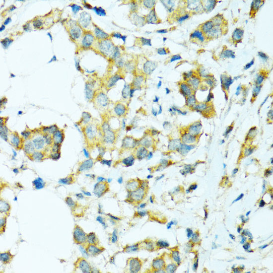 Immunohistochemistry of paraffin-embedded Human breast cancer using CYP2B6 Polyclonal Antibody at dilution of  1:100 (40x lens).