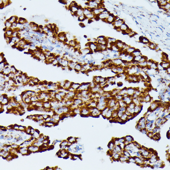 Immunohistochemistry of paraffin-embedded Human thyroid cancer using IDH3A Polyclonal Antibody at dilution of  1:100 (40x lens).