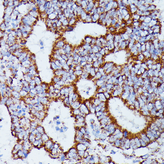 Immunohistochemistry of paraffin-embedded Human colon carcinoma using IDH3A Polyclonal Antibody at dilution of  1:100 (40x lens).