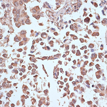 Immunohistochemistry of paraffin-embedded Human lung cancer using NFE2L1 Polyclonal Antibody at dilution of  1:100 (40x lens).