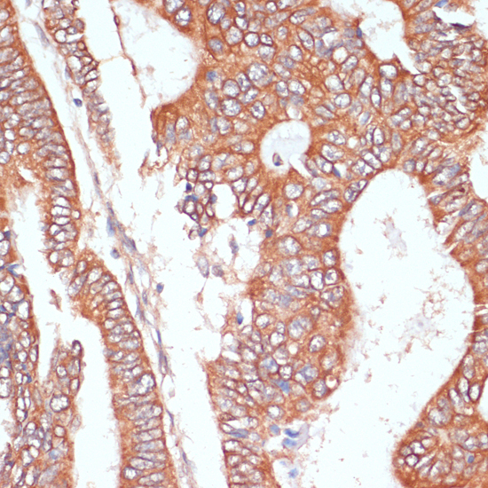 Immunohistochemistry of paraffin-embedded Human colon carcinoma using PTPRN2 Polyclonal Antibody at dilution of  1:100 (40x lens).