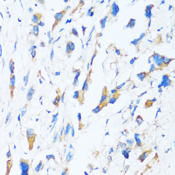 Immunohistochemistry of paraffin-embedded Human lung cancer using BAG3 Polyclonal Antibody at dilution of  1:100 (40x lens).