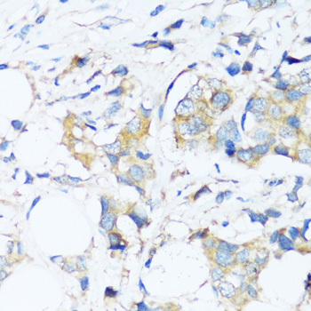 Immunohistochemistry of paraffin-embedded Human breast cancer using BAG3 Polyclonal Antibody at dilution of  1:100 (40x lens).