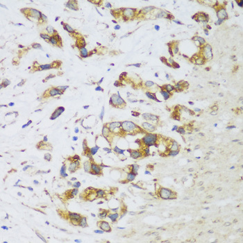 Immunohistochemistry of paraffin-embedded Human gastric cancer using ERLIN1 Polyclonal Antibody at dilution of  1:100 (40x lens).