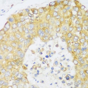 Immunohistochemistry of paraffin-embedded Human liver cancer using ERLIN1 Polyclonal Antibody at dilution of  1:100 (40x lens).