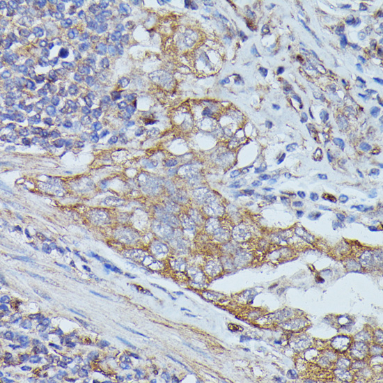 Immunohistochemistry of paraffin-embedded Human lung cancer using CTTN Polyclonal Antibody at dilution of  1:100 (40x lens).