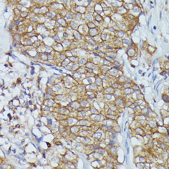 Immunohistochemistry of paraffin-embedded Human mammary cancer using CTTN Polyclonal Antibody at dilution of  1:100 (40x lens).