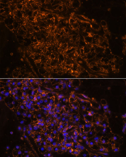 Immunofluorescence analysis of Human kidney cancer using SCNN1G Polyclonal Antibody at dilution of  1:100. Blue: DAPI for nuclear staining.