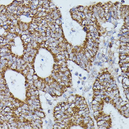 Immunohistochemistry of paraffin-embedded Human colon carcinoma using FLII Polyclonal Antibody at dilution of  1:100 (40x lens).