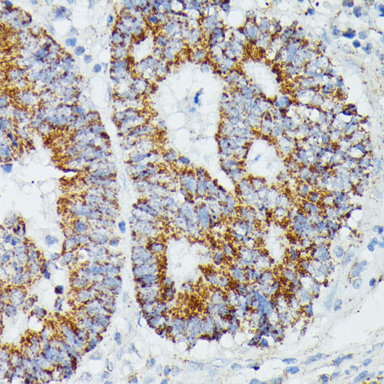 Immunohistochemistry of paraffin-embedded Human colon carcinoma using IVD Polyclonal Antibody at dilution of  1:100 (40x lens).