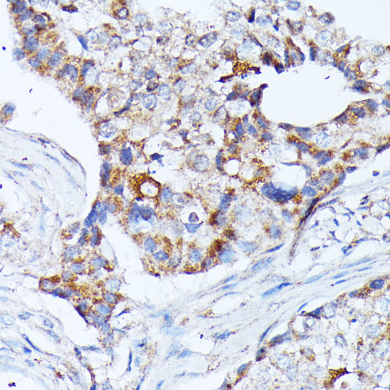 Immunohistochemistry of paraffin-embedded Human breast cancer using KCNJ15 Polyclonal Antibody at dilution of  1:100 (40x lens).