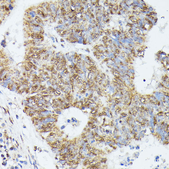 Immunohistochemistry of paraffin-embedded Human colon carcinoma using KIF22 Polyclonal Antibody at dilution of  1:100 (40x lens).