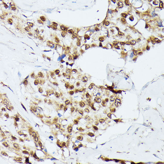 Immunohistochemistry of paraffin-embedded Human breast cancer using KIF22 Polyclonal Antibody at dilution of  1:100 (40x lens).