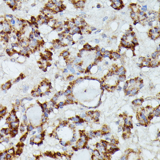 Immunohistochemistry of paraffin-embedded Human thyroid cancer using MANBA Polyclonal Antibody at dilution of  1:100 (40x lens).