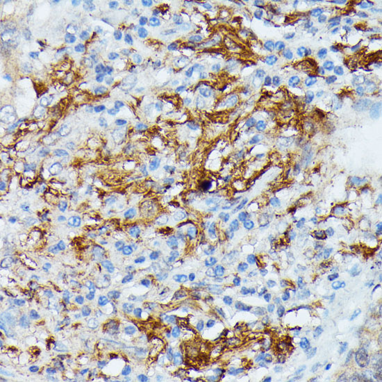 Immunohistochemistry of paraffin-embedded Human lung cancer using RNASE6 Polyclonal Antibody at dilution of  1:100 (40x lens).