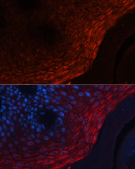 Immunofluorescence analysis of Human skin cancer using S100A8 Polyclonal Antibody at dilution of  1:100 (40x lens). Blue: DAPI for nuclear staining.