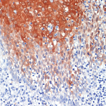 Immunohistochemistry of paraffin-embedded Human tonsil using S100A8 Polyclonal Antibody at dilution of  1:200 (40x lens).