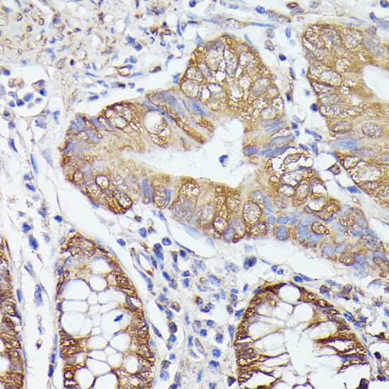 Immunohistochemistry of paraffin-embedded Human colon carcinoma using TRIP4 Polyclonal Antibody at dilution of  1:100 (40x lens).