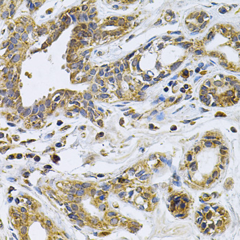 Immunohistochemistry of paraffin-embedded Human breast cancer using DRD3 Polyclonal Antibody at dilution of  1:100 (40x lens).