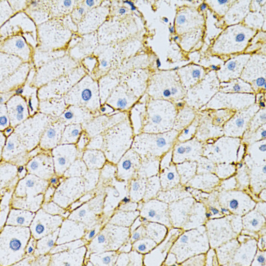 Immunohistochemistry of paraffin-embedded Human liver damage using BSG Polyclonal Antibody at dilution of  1:200 (40x lens).