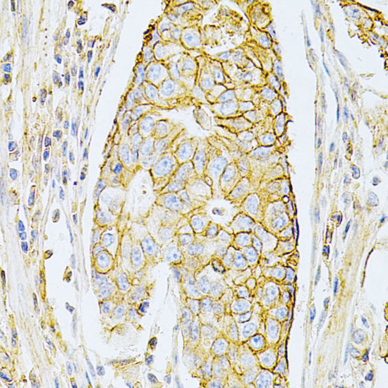 Immunohistochemistry of paraffin-embedded Human gastric cancer using BSG Polyclonal Antibody at dilution of  1:200 (40x lens).