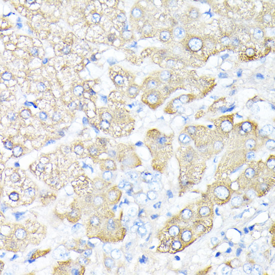 Immunohistochemistry of paraffin-embedded Human liver cancer using HP Polyclonal Antibody at dilution of  1:100 (40x lens).