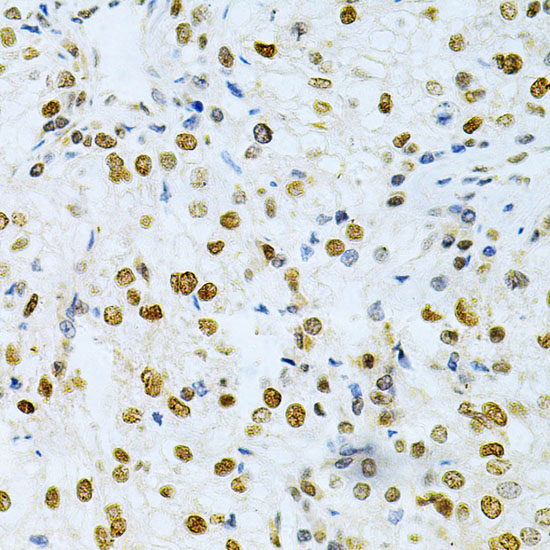 Immunohistochemistry of paraffin-embedded Human kidney cancer using HuR / ELAVL1 Polyclonal Antibody at dilution of  1:200 (40x lens).