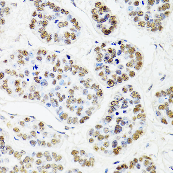 Immunohistochemistry of paraffin-embedded Human esophageal cancer using CDX2 Polyclonal Antibody at dilution of  1:100 (40x lens).