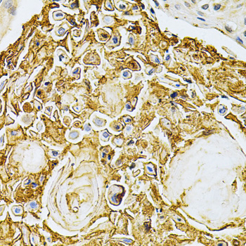 Immunohistochemistry of paraffin-embedded Human esophageal cancer using ADRBK1 Polyclonal Antibody at dilution of  1:200 (40x lens).