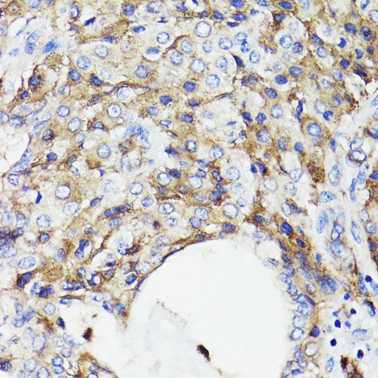 Immunohistochemistry of paraffin-embedded Human lung cancer using CD59 Polyclonal Antibody at dilution of  1:100 (40x lens).