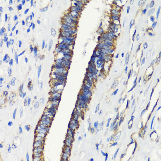 Immunohistochemistry of paraffin-embedded Human uterine cancer using FKBP1A Polyclonal Antibody at dilution of  1:200 (40x lens).