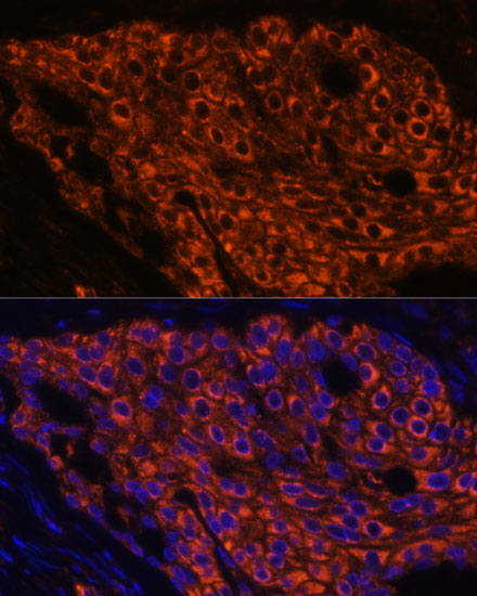 Immunofluorescence analysis of Human lung cancer using SFTPC Polyclonal Antibody at dilution of  1:100 (40x lens). Blue: DAPI for nuclear staining.