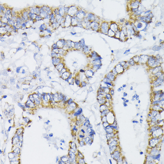 Immunohistochemistry of paraffin-embedded Human colon carcinoma using PDHA1 Polyclonal Antibody at dilution of  1:200 (40x lens).