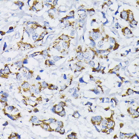 Immunohistochemistry of paraffin-embedded Human mammary cancer using PDHA1 Polyclonal Antibody at dilution of  1:200 (40x lens).