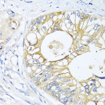 Immunohistochemistry of paraffin-embedded Human colon carcinoma using GNAI3 Polyclonal Antibody at dilution of  1:100 (40x lens).