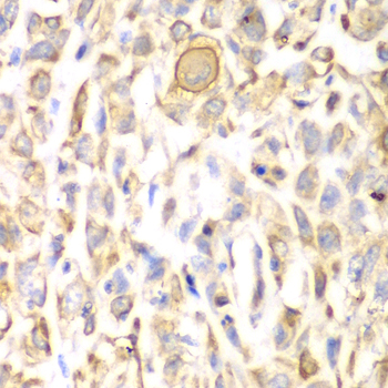 Immunohistochemistry of paraffin-embedded Human lung cancer using CD151 Polyclonal Antibody at dilution of  1:200 (40x lens).