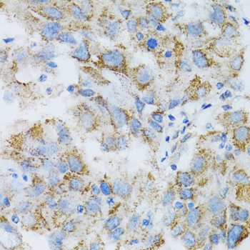 Immunohistochemistry of paraffin-embedded Human breast cancer using PSMD10 Polyclonal Antibody at dilution of  1:100 (40x lens).