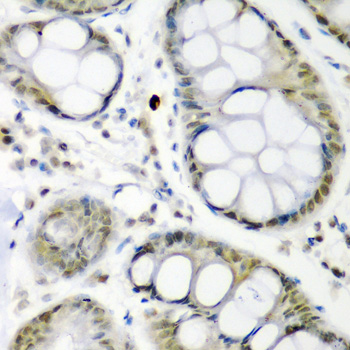 Immunohistochemistry of paraffin-embedded Human colon carcinoma using CDC27 Polyclonal Antibody at dilution of  1:200 (40x lens).