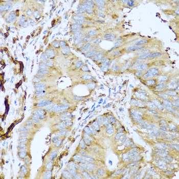 Immunohistochemistry of paraffin-embedded Human colon carcinoma using CSH1 Polyclonal Antibody at dilution of  1:100 (40x lens).