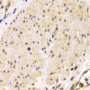 Immunohistochemistry of paraffin-embedded Human stomach cancer using TMPRSS2 Polyclonal Antibody at dilution of  1:200 (40x lens).