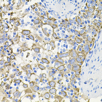 Immunohistochemistry of paraffin-embedded Human esophageal cancer using ACVR2A Polyclonal Antibody at dilution of  1:100 (40x lens).