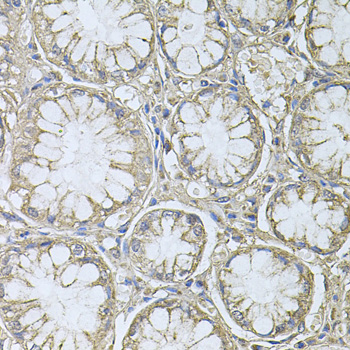 Immunohistochemistry of paraffin-embedded Human gastric cancer using PTP4A3 Polyclonal Antibody at dilution of  1:100 (40x lens).