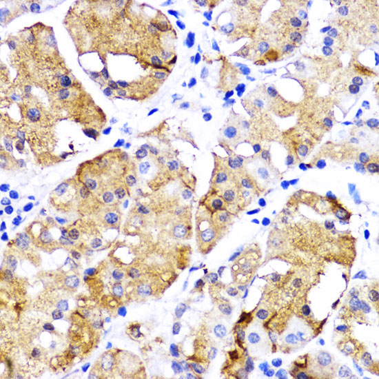 Immunohistochemistry of paraffin-embedded Human gastric cancer using BMPR1B Polyclonal Antibody at dilution of  1:200 (40x lens).