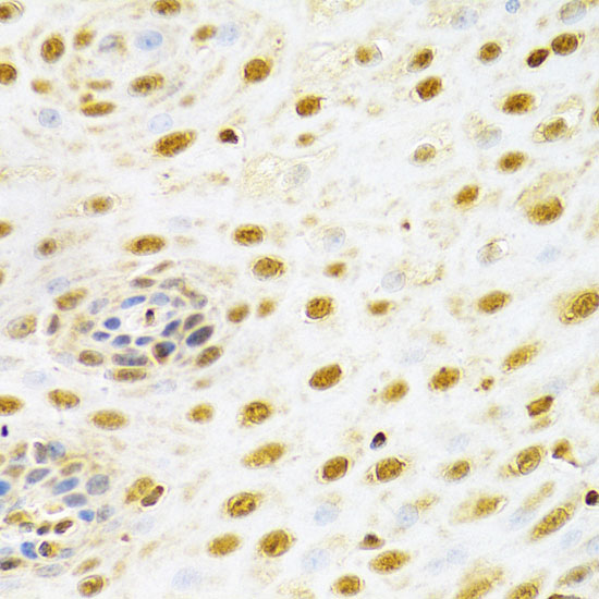 Immunohistochemistry of paraffin-embedded Human esophageal cancer using RUNX1 Polyclonal Antibody at dilution of  1:100 (40x lens).